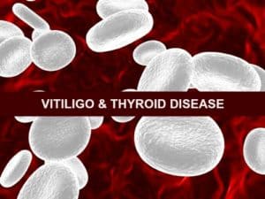 Vitilito Thyroid Disease Connection