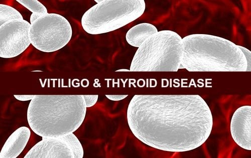 Vitilito Thyroid Disease Connection