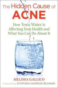 Hidden Causes of Acne Book Cover